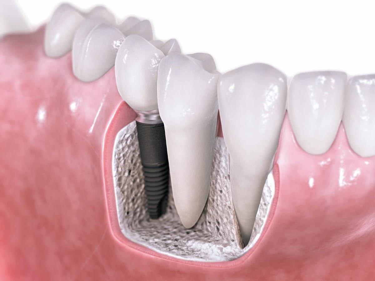 Odonto Mathias Velho - Próteses e Implantes Canoas em Canoas